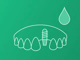 Single-tooth (Cement retained)