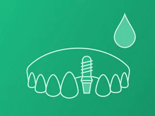 Single-tooth (Cement retained)