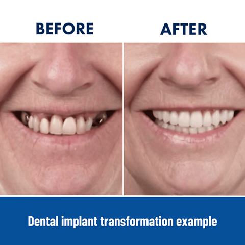 Dental implants before & after woman patient example