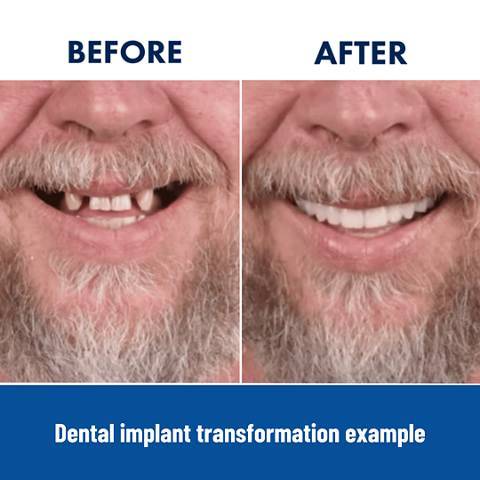 Dental implant before & after example for a man patient