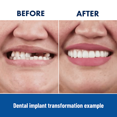 Dental implant treatment before & after woman