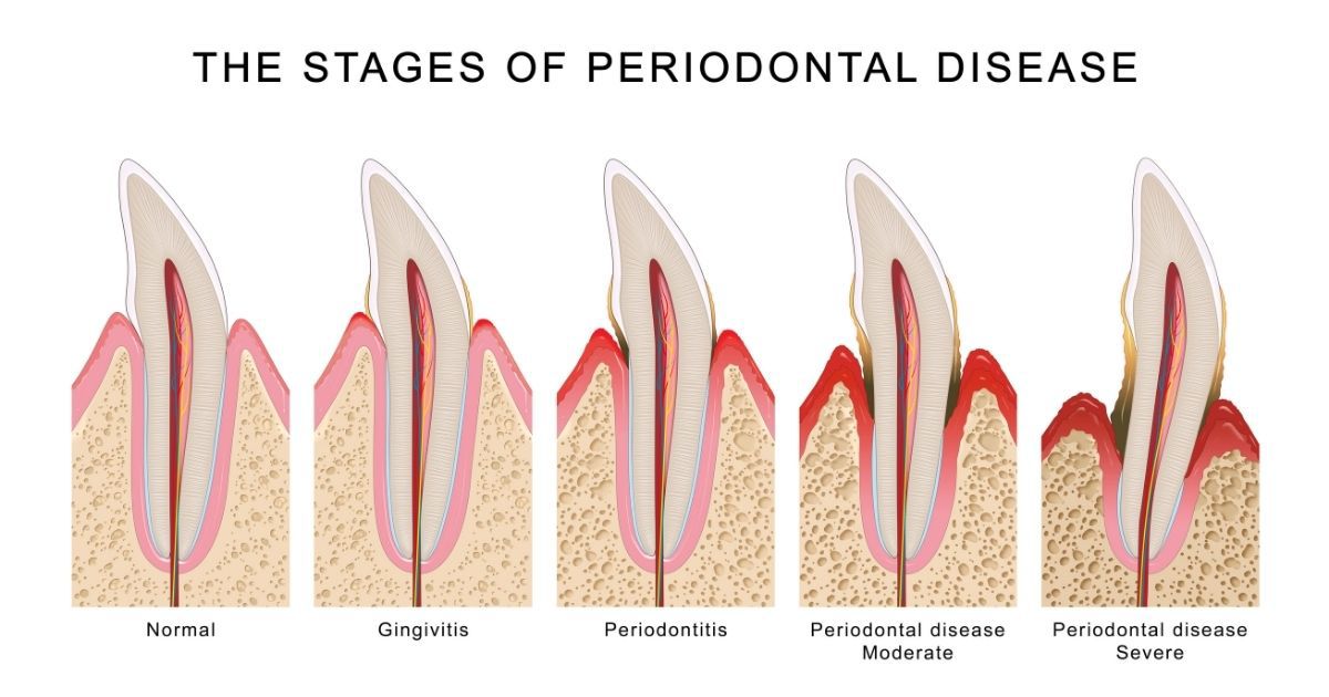 the stage of periodontal disease