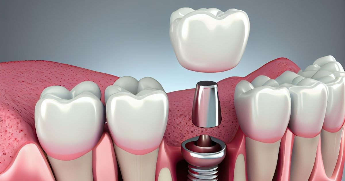 Healing abutments for dental implants shown being inserted