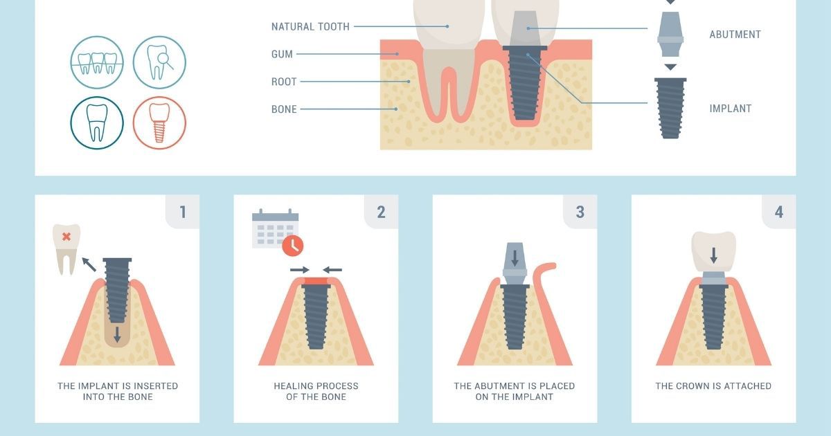 Abutment being used in dental implant procedure