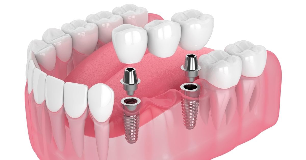 dental implant bridge